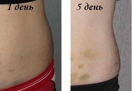 мезотерапия для похудения фото до и после