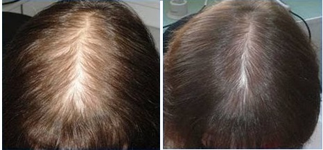 результаты после 6 мес. втирания никотиновой кислоты: рос и густота волос